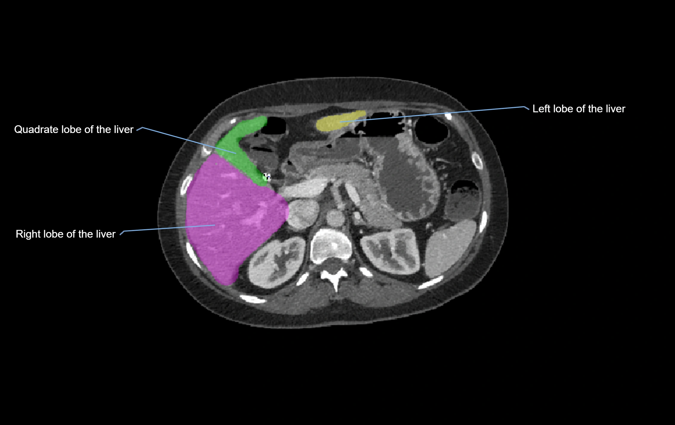 CT lliver lobes axial cross sectional anatomy labelled image -00040.webp